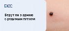 Берут ли в армию с родимым пятном